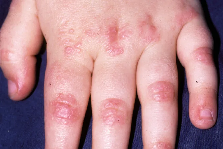 photo of dermatomyositis on child's hand