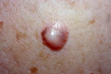 Desmoplastic melanoma is a rare and invasive form of skin cancer that represents about 4 percent of all skin melanomas. The malignant cells are within the dermis and are surrounded by fibrous tissue so they may look like a scar in texture and appearance. It is usually found in older individuals who have sun damaged skin and is most often found on areas of the skin exposed to the sun such as the face, neck, scalp, legs, and arms.