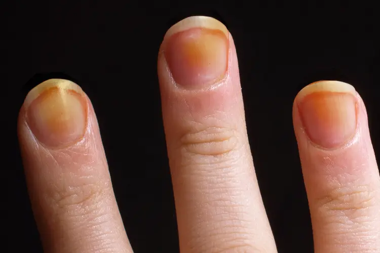 photo of discoloration of nail plates
