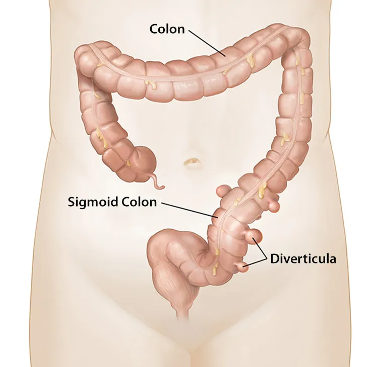 illustration of colon with diverticula