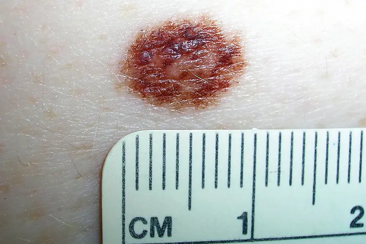 photo of dysplastic nevus