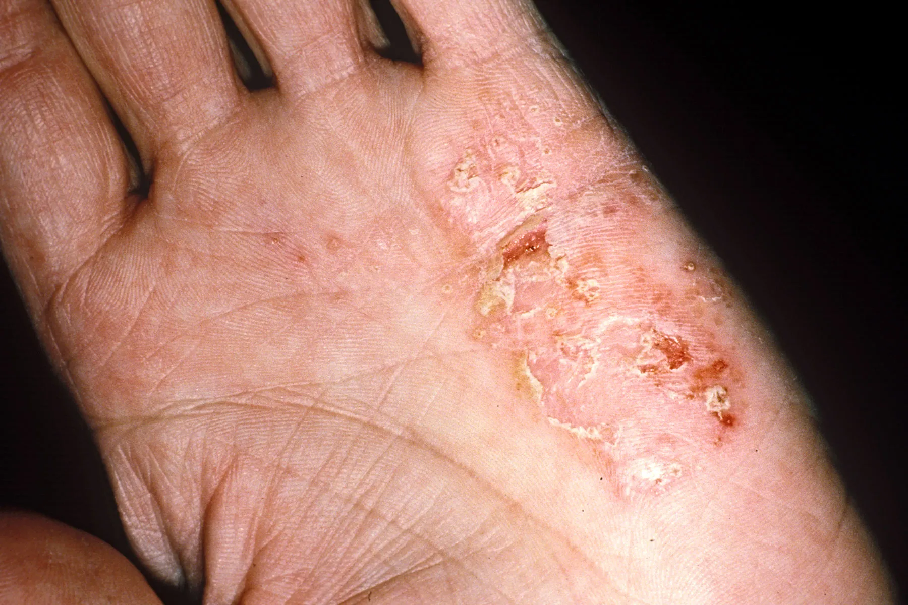 photo of eczema on hand