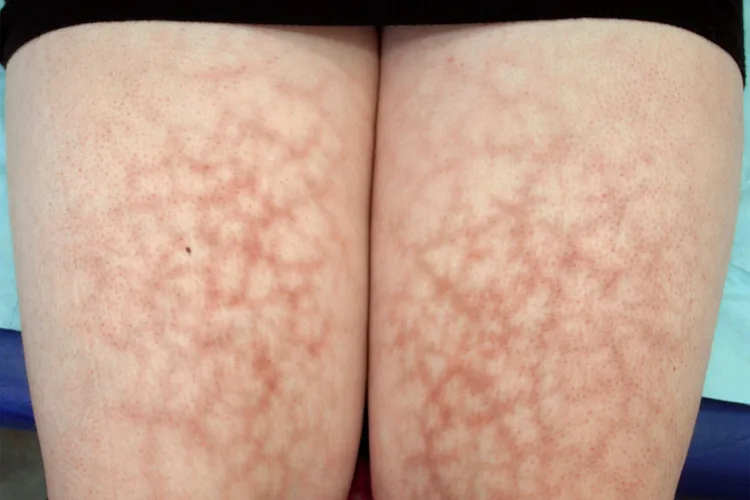 Erythema ab igne is a type of rash that looks like a fishnet pattern. It happens after repeated exposure to heat from sources like laptops, heating pads, or heated car seats. (Photo Credit: High-Definition Dermatologist / Medical Images)