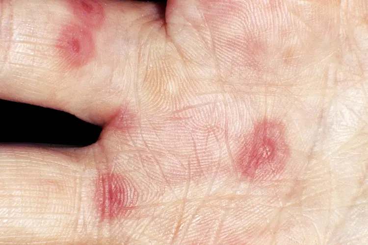 photo of erythema multiforme minor