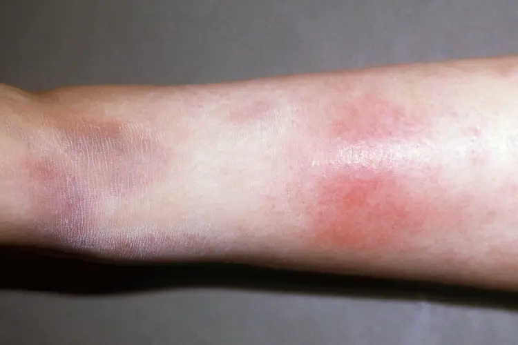 photo of erythema nodosum on leg
