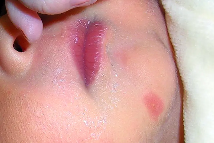 photo of  erythema toxicum neonatorum