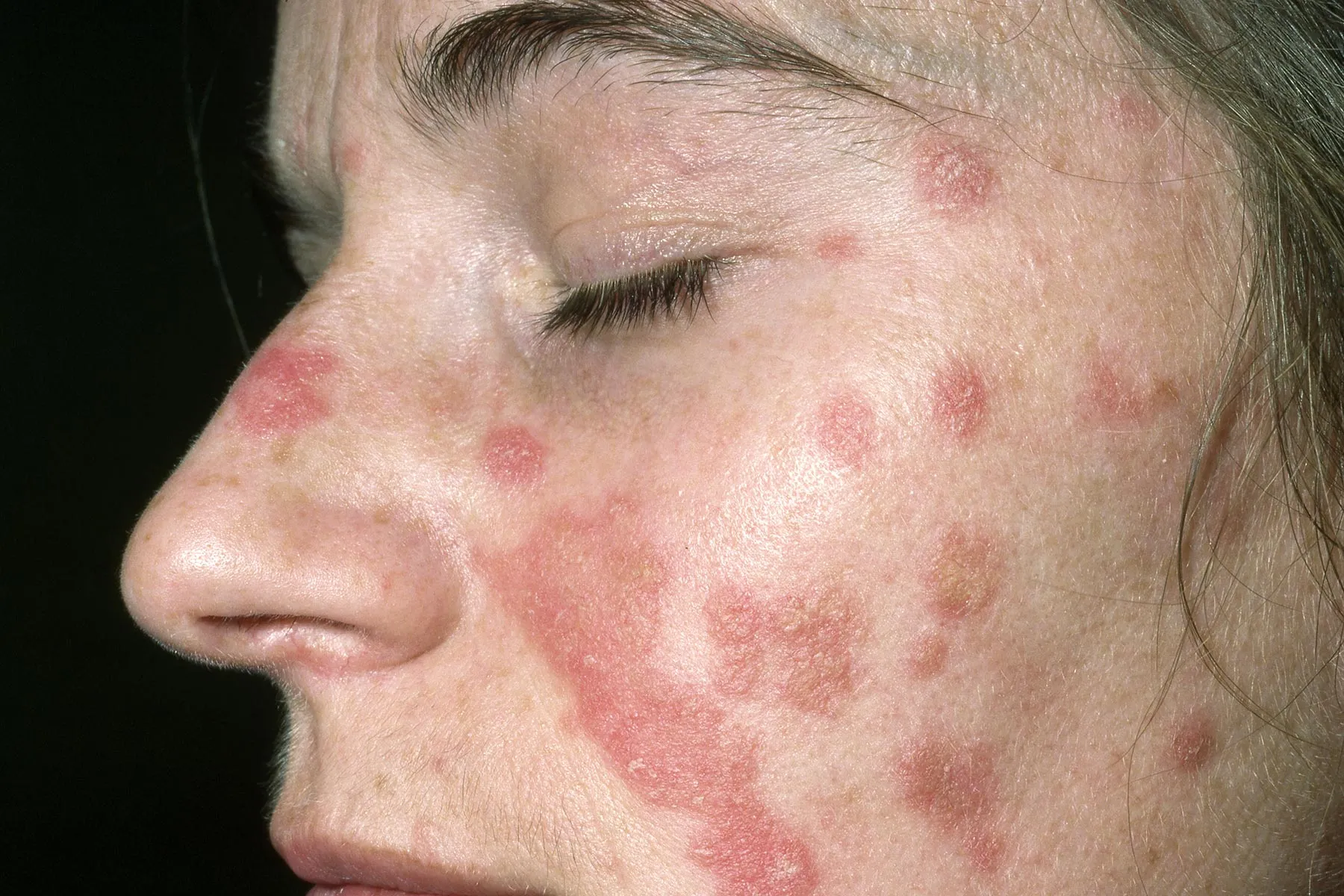 Detailed Can You Get Psoriasis On Your Face Photo for Desktop