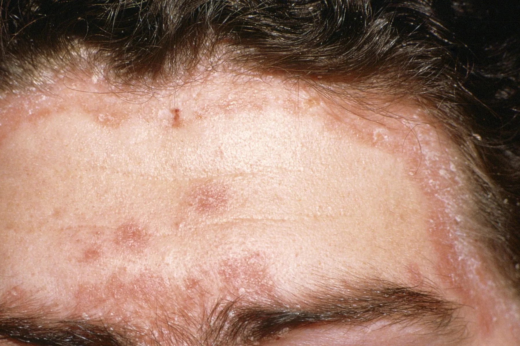 Captivating Can You Get Psoriasis On Your Face Photo for Desktop