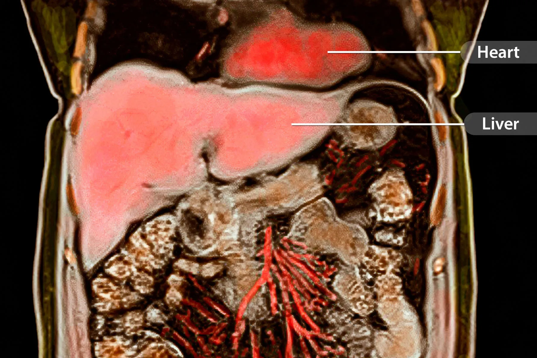 Fatty Liver Disease and Heart Disease