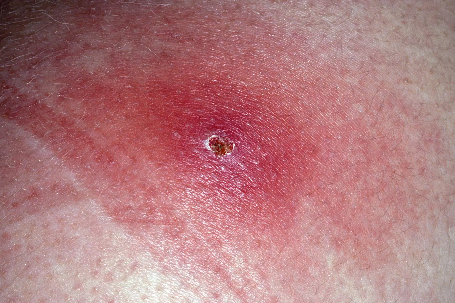 photo of furuncle s aureus