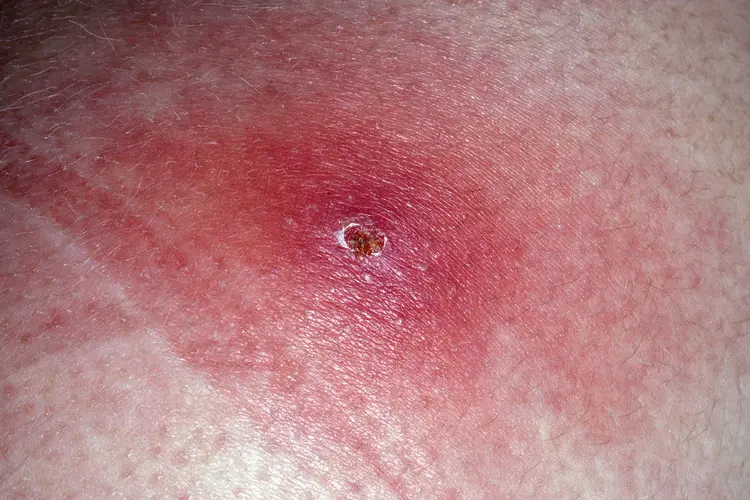 photo of furuncle s aureus