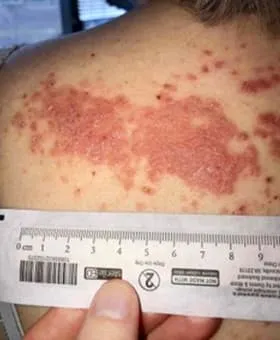 photo of psoriasis on back