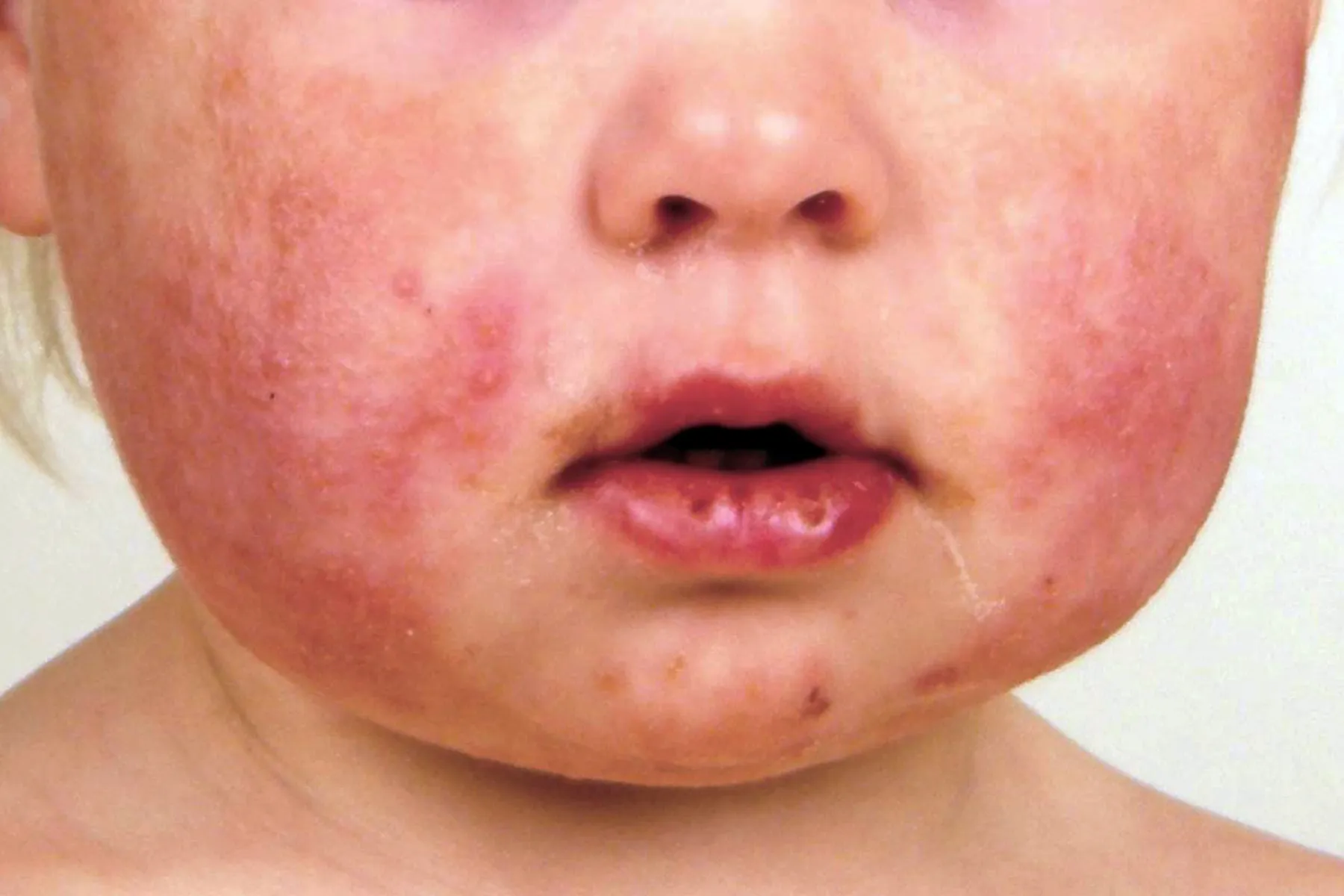 photo of gianotti crosti syndrome