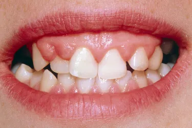 Gingival hyperplasia from phenytoin. Gingival hyperplasia can result in some patients who are taking the anti-seizure medication phenytoin. About 50% of those taking phenytoin will have swelling or overgrowth of their gum tissue.