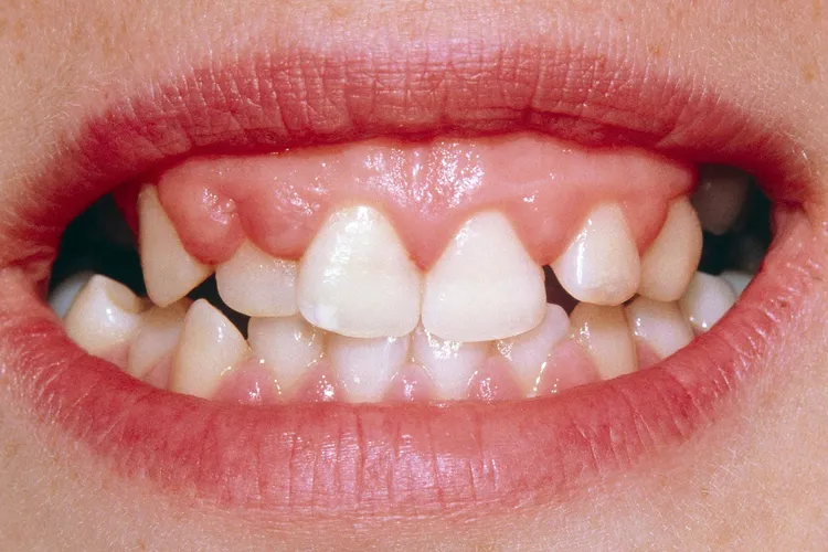 photo of gingival hyperplasia from phenytoin
