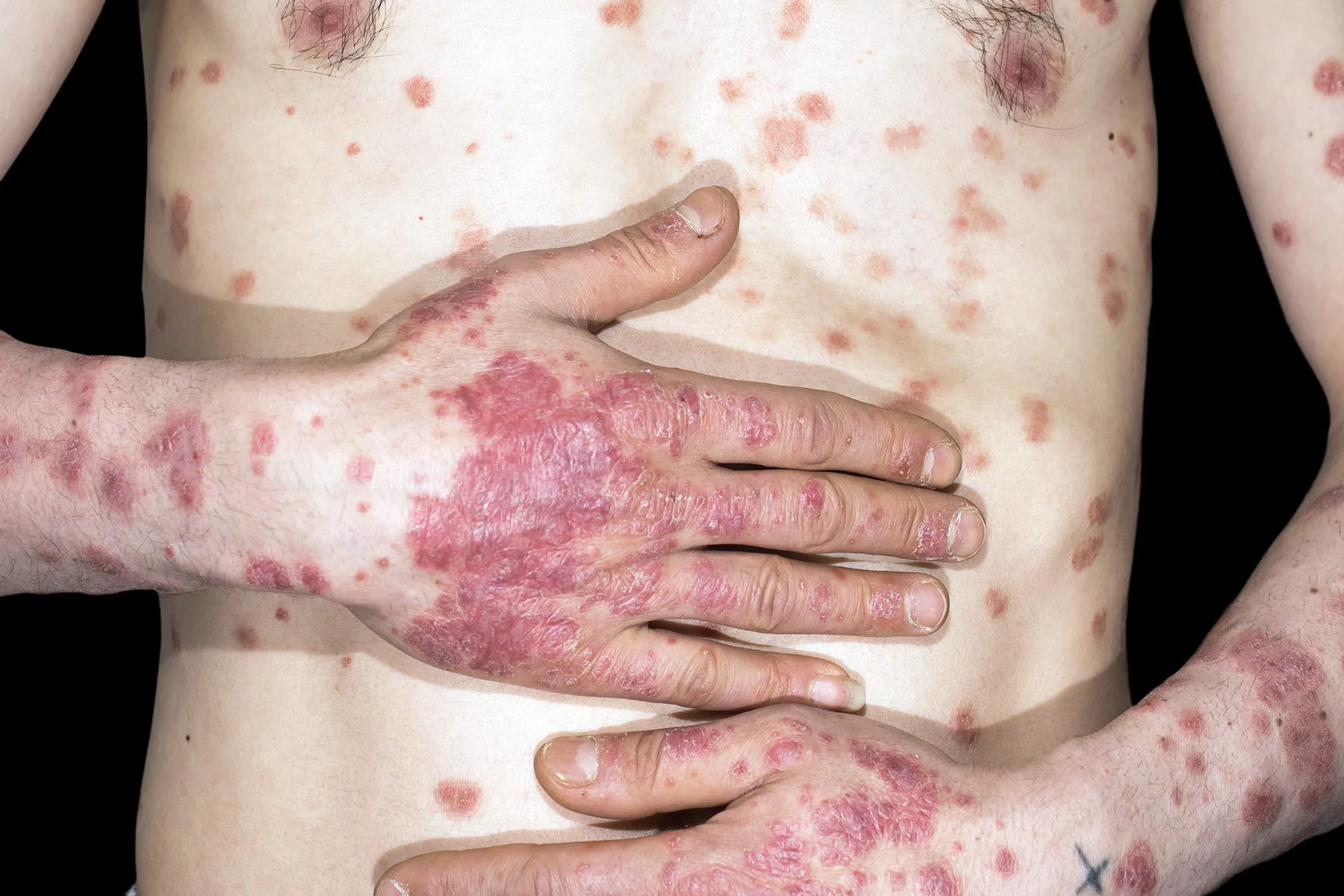 photo of guttate psoriasis