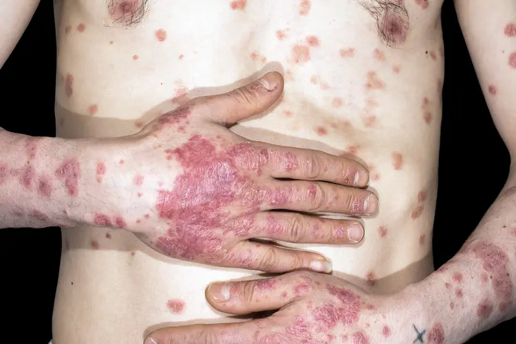 photo of guttate psoriasis