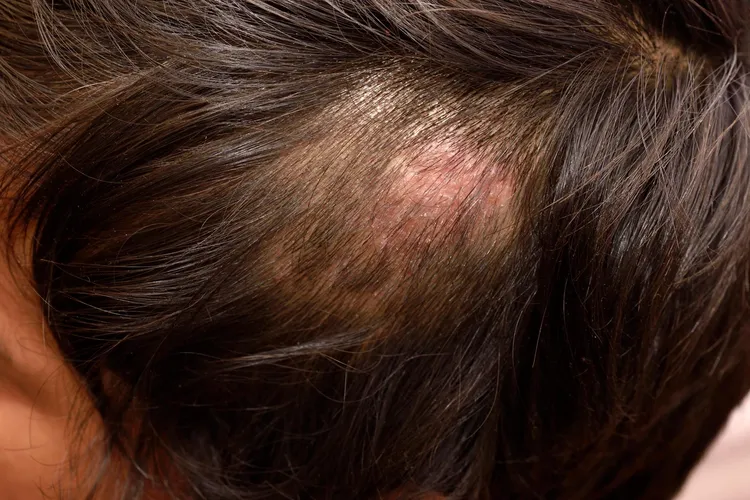 photo of ringworm in scalp