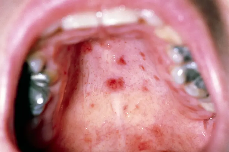 photo of hand foot and mouth disease in mouth