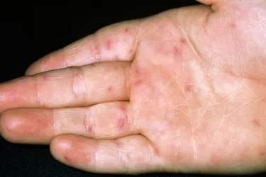 In the second stage of a hand, foot, and mouth infection, a rash and blisters may appear on your hands. (Photo Credit: Science Photo Library / Science Source)