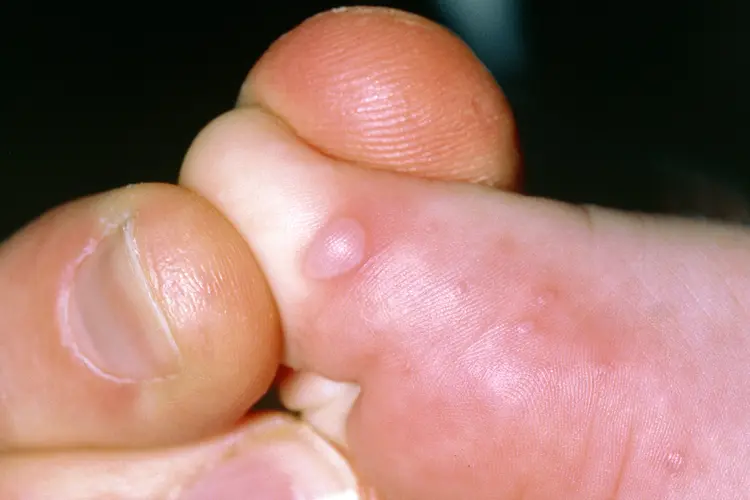 photo of hand foot mouth disease on foot
