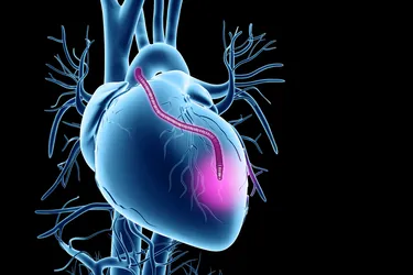 In heart bypass surgery, a blood vessel from another part of your body is used to create a new route for blood flow around a blocked artery. (Photo Credit: SCIENCE PHOTO LIBRARY/Getty Images)