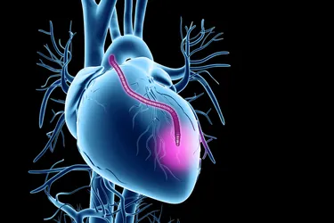 photo of heart bypass graft