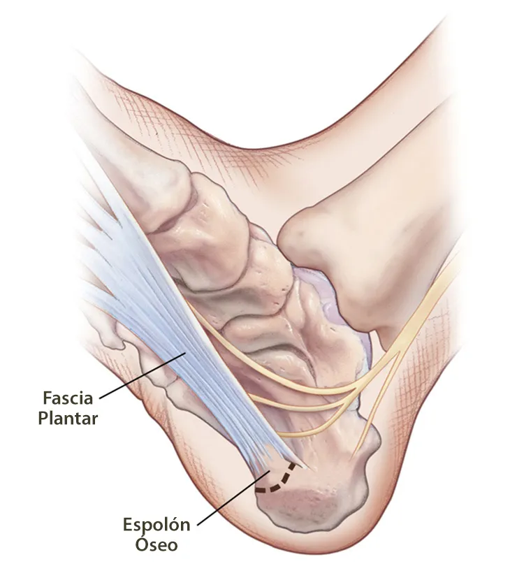 Ilustración de la fascitis plantar.