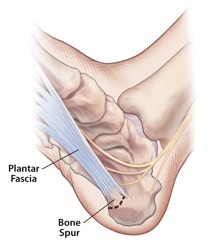 illustration of bone spur/plantar fasciitis