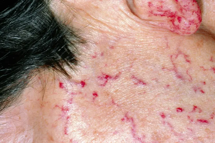 photo of hereditary hemorrhagic telangiectasia