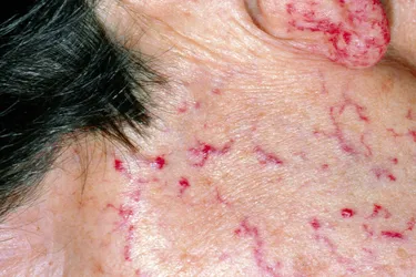 Also called Osler-Rendu-Weber syndrome, hereditary hemorrhagic telangiectasia is an inherited condition that causes malformations of blood capillaries that develop on the skin and mucous membranes. They may cause nose bleeds and iron deficiency anemia resulting from bleeding in the stomach or elsewhere in the gastrointestinal tract.