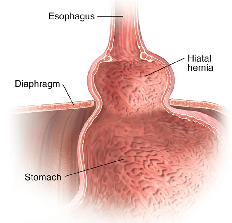 illustration of hiatal hernia