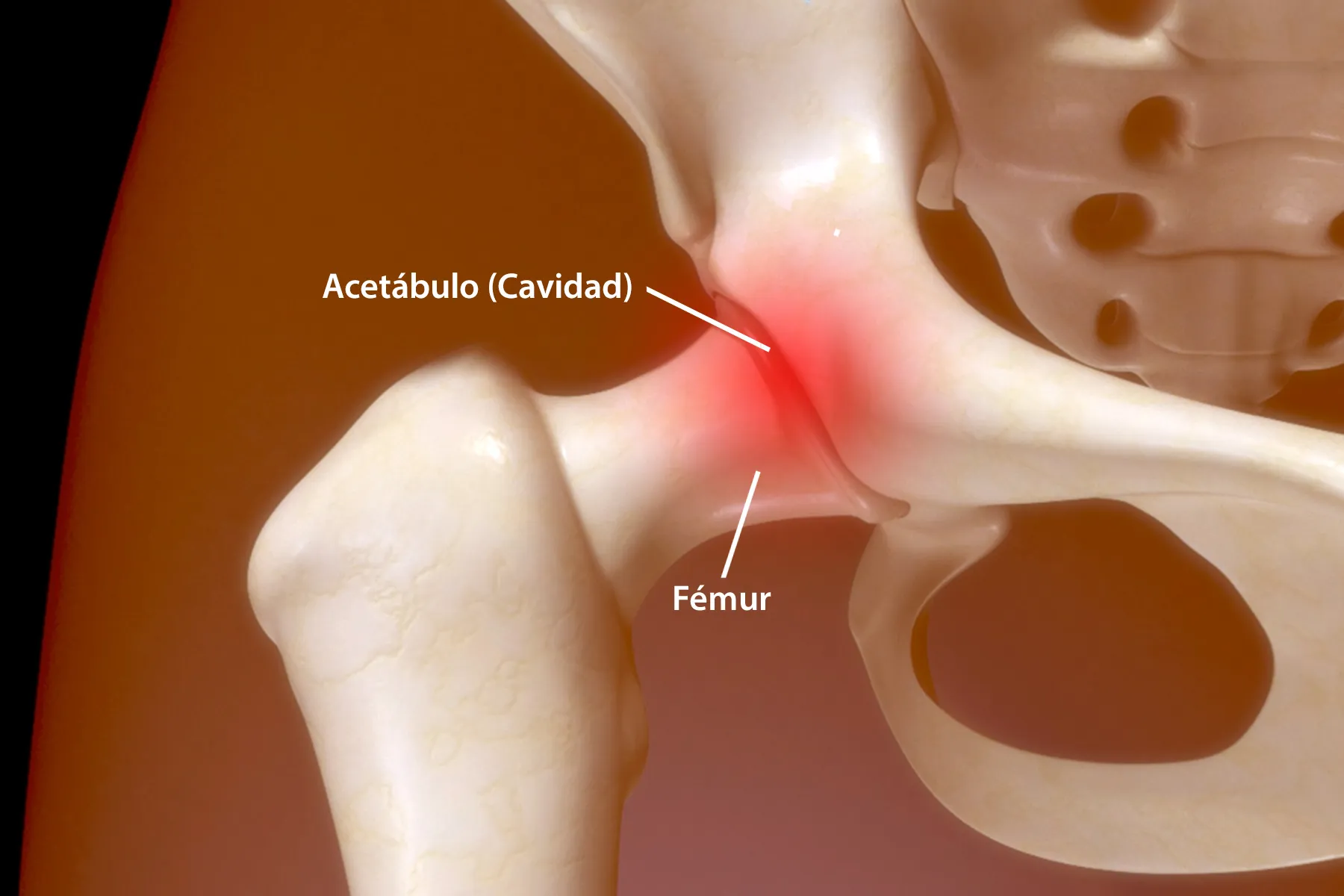 Ilustración de la anatomía de la cadera dolorida.