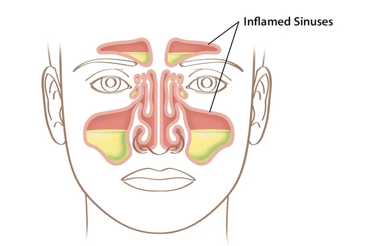 illustration of inflamed sinuses