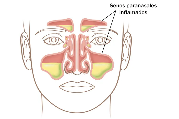 Ilustración de senos paranasales inflamados: congestión nasal y sinusitis