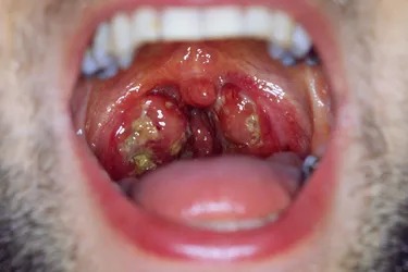 Infectious mononucleosis. Swollen tonsils that appear red and with white lesions that may be oozing pus are a hallmark of infectious mononucleosis. It is considered highly contagious and is usually caused by the Epstein-Barr Virus (EBV). Mono spreads through saliva and therefore is sometimes called “kissing disease.”