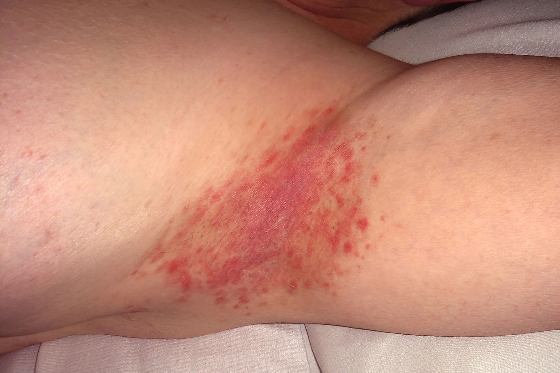 photo of inverse psoriasis on armpit