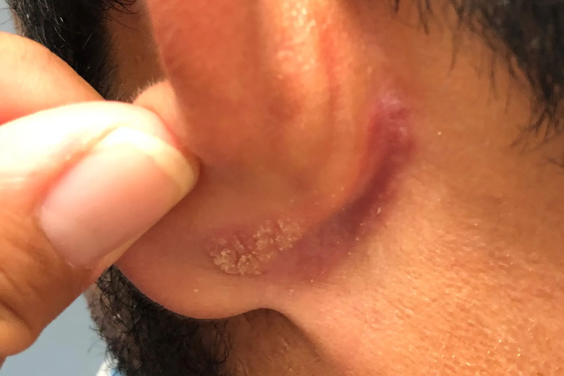 photo of inverse psoriasis behind ear