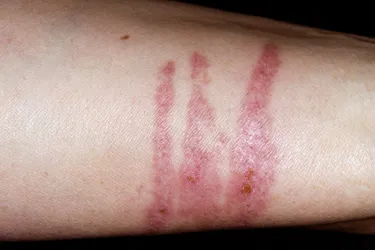 Jellyfish envenomation. Jellyfish have stingers that are capable of piercing the skin and leaving a toxic venom that result in red, painful welts in the area of contact – in this case, on the patient’s arm.