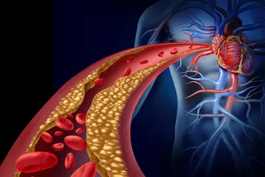 clogged artery illustration