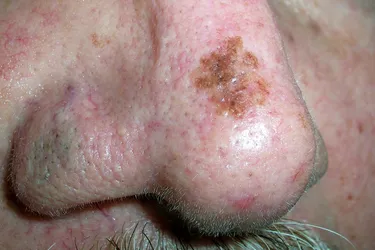 Lentigo maligna melanoma. Lentigo maligna melanoma usually develops on the face or nose from a melanotic freckle, often spreading aggressively.  It is asymmetric, with jagged borders, has several colors, and can change appearance quickly. It should be treated as soon as it's diagnosed to avoid it spreading further, likely with surgery.
