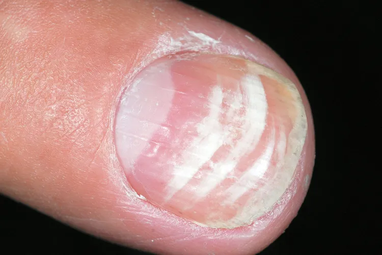 photo of lleukonychia striata on fingernail
