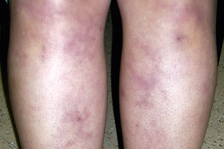 photo of livedo reticularis on legs