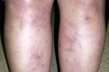 Livedo reticularis. Also called marbled skin, livedo reticularis is a normal and usually harmless body response that causes your skin to become pale and covered in red or purple patterns. It’s usually caused by cold temperatures and will go away without treatment.