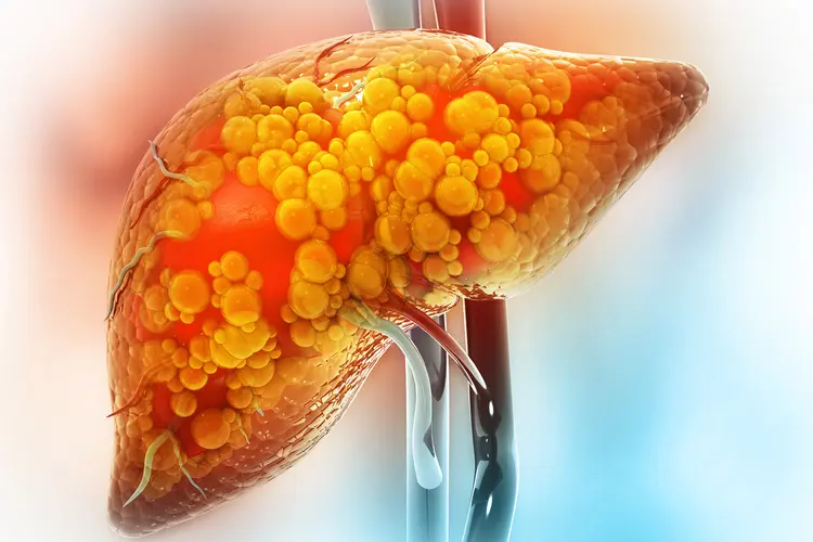 photo of diseased liver