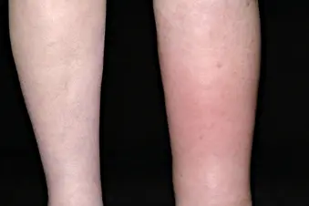 photo of lymphedemia