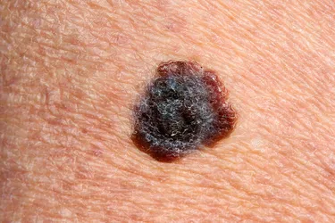 Malignant melanoma is the most serious skin cancer and can spread to other places in your body and cause death. Melanomas start as changes to an existing mole. The shape becomes asymmetrical, and the color becomes uneven. It may start to grow and become hard or lumpy. They are aggressive and should be surgically removed. Melanomas occur in the cells (melanocytes) that produce the melanin which gives skin its color. The main cause of melanoma is exposure to ultraviolet radiation in sunlight.