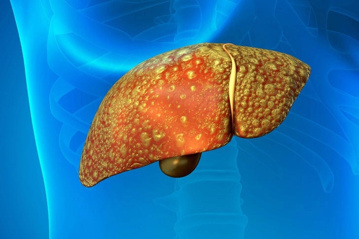 Which Tests Can Detect Advanced Liver Fibrosis?