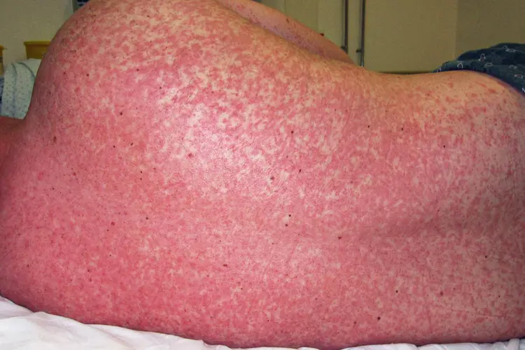 photo of measles on back