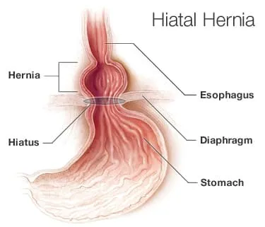 Picture of hiatal hernia
